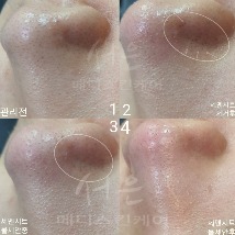 아크네전문 서은메디스킨케어