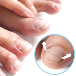 퍼펙토 내성발톱 교정기 스트립 의료기기 테이프 세트 파고드는 발톱 밴드 자가치료 와이어