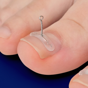 퍼펙토 픽스 내성발톱 교정기 단품 와이어 의료기기 파고드는 발톱 자가치료